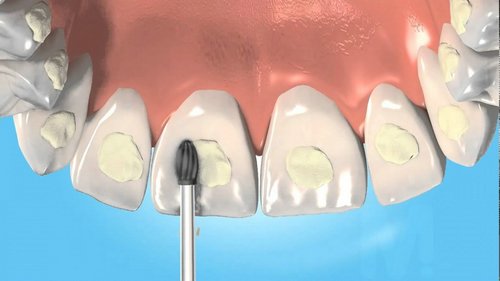 Ортодонтические адгезивы: предназначение и способы применения